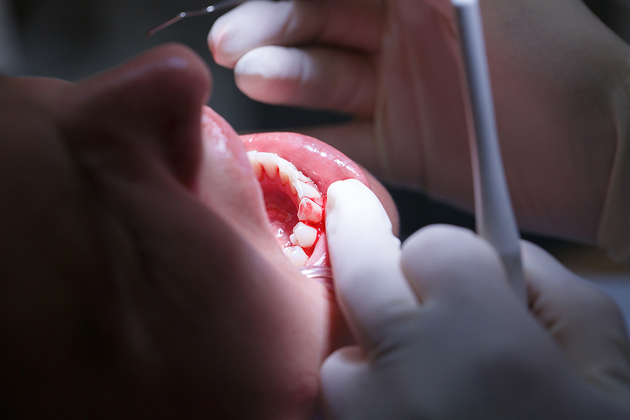 Comprehensive Guide to Periodontal Treatment: Restoring Healthy Gums in Santa Clara, CA