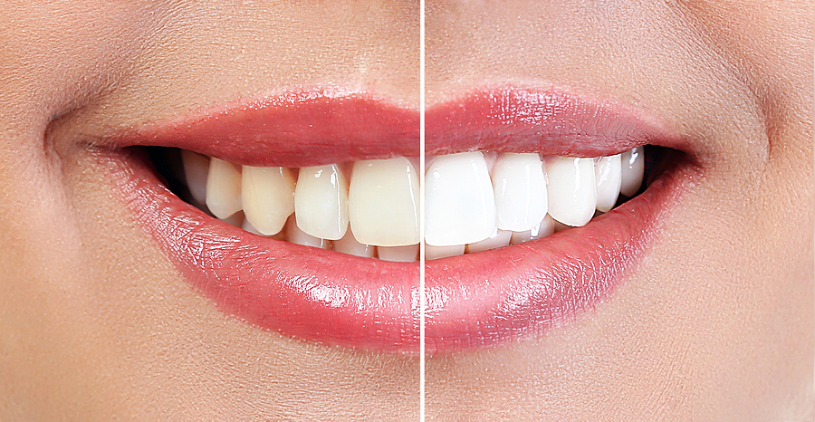 Achieve a Brighter Smile with Professional Teeth Whitening in Santa Clara, CA