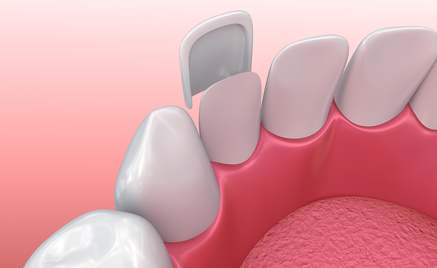 Transform Your Smile with Veneers in Santa Clara, CA