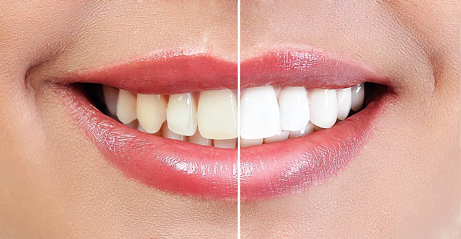 Achieve a Brighter Smile with Professional Teeth Whitening in Santa Clara CA