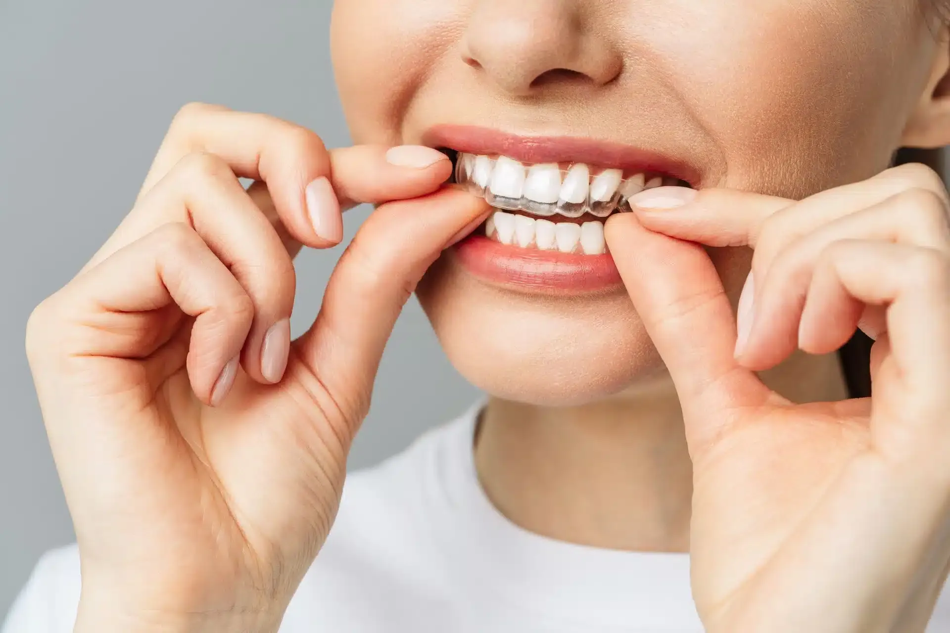 How to Care for Your Invisalign Aligners in Santa Clara CA: Dos and Don’ts