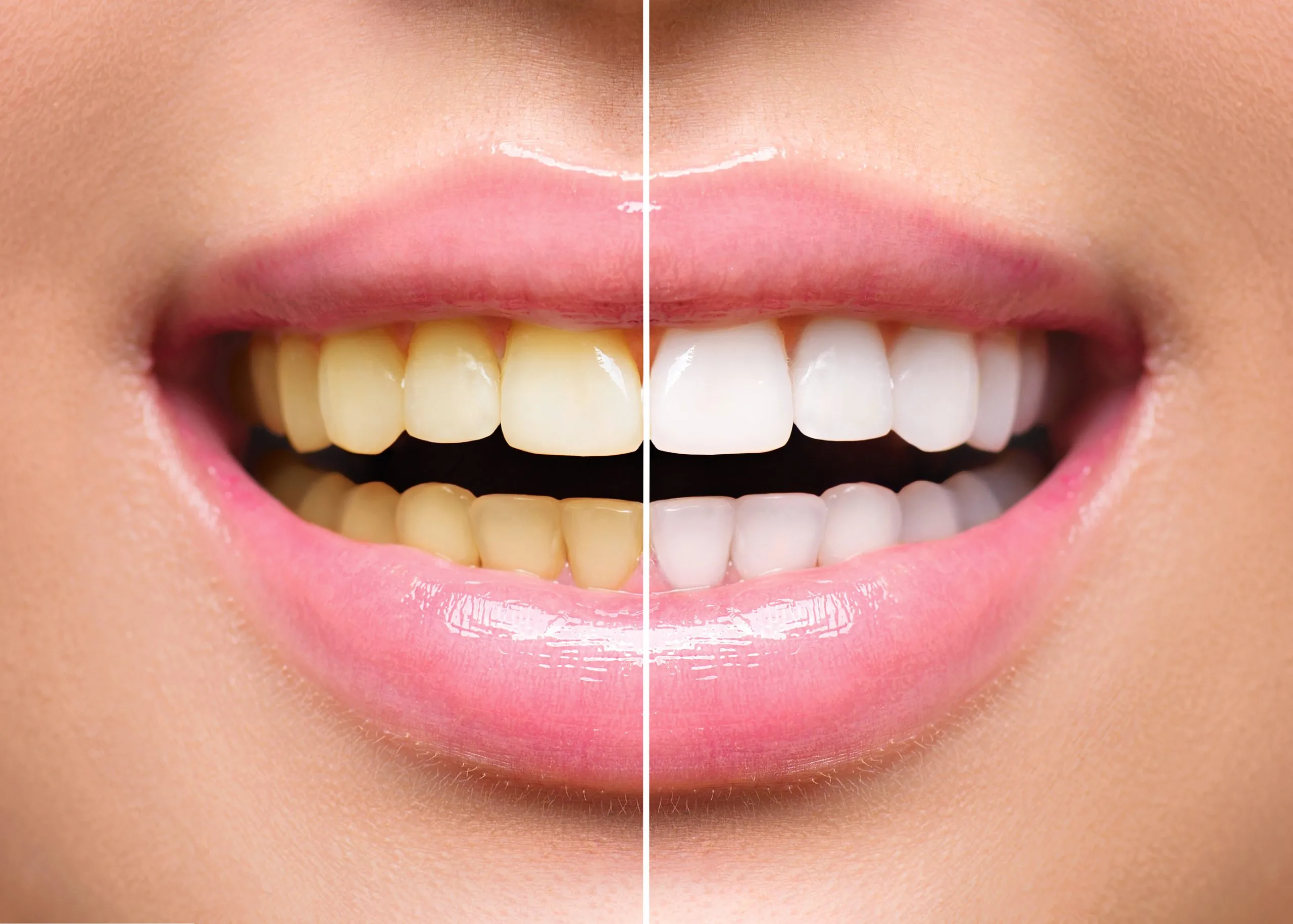 Brightening Your Smile: The Benefits of Teeth Whitening in Santa Clara CA
